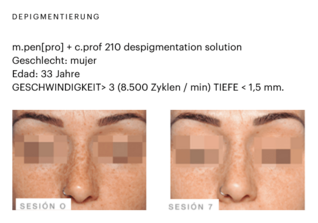 Vorher-Skin-Effect-Nachher